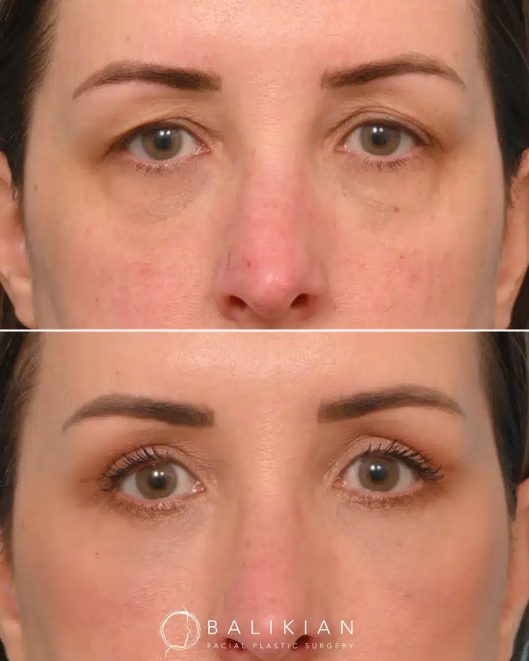 Eyelid Surgery: The Procedure That Changes How Rested You Look
